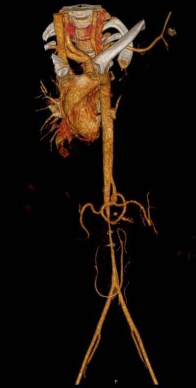 Severe abdominal aortic stenosis (3mm) at level of Superior Mesenteric Artery (SMA) including both renal arteries until the aortic bifurcation level.